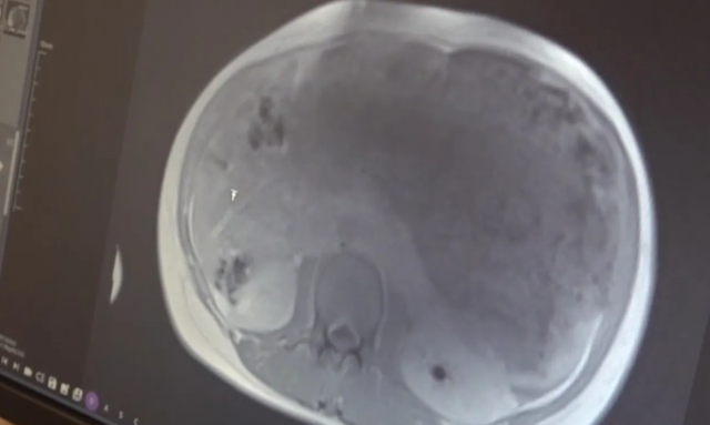 Midesinde sertlik fark etti, hastanede karnından iki bebek büyüklüğünde tümör çıkarıldı Midesinde sertlik fark etti, hastanede karnından iki bebek büyüklüğünde tümör çıkarıldı